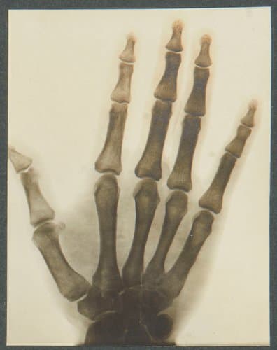 This radiograph of an uninjured hand belonging to an Indian soldier of the First World War was taken to draw comparison with an injured hand, 1914-15, and is from the collection of King George V; 3-3/4” x 3”.